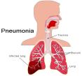 Pneumonia disease